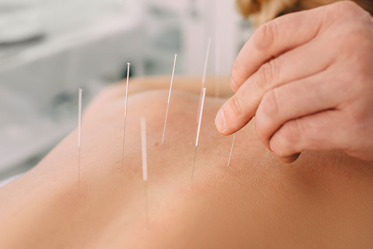 Βελονιστής βάζει βελόνες στην πλάτη ασθενούς